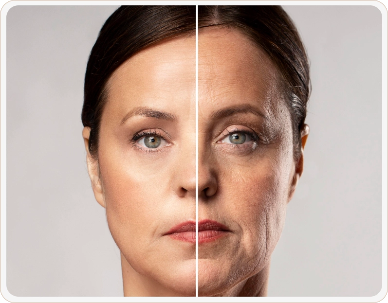 blefaroplastia antes e depois