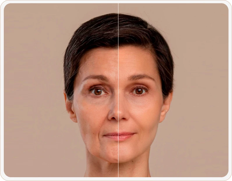 antes e depois laser co2 elleve plástica ocular